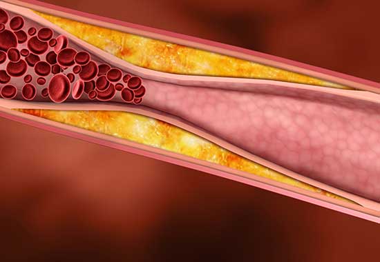 Cholestérol et Pilule : suivre un régime anti cholestérol si le ...